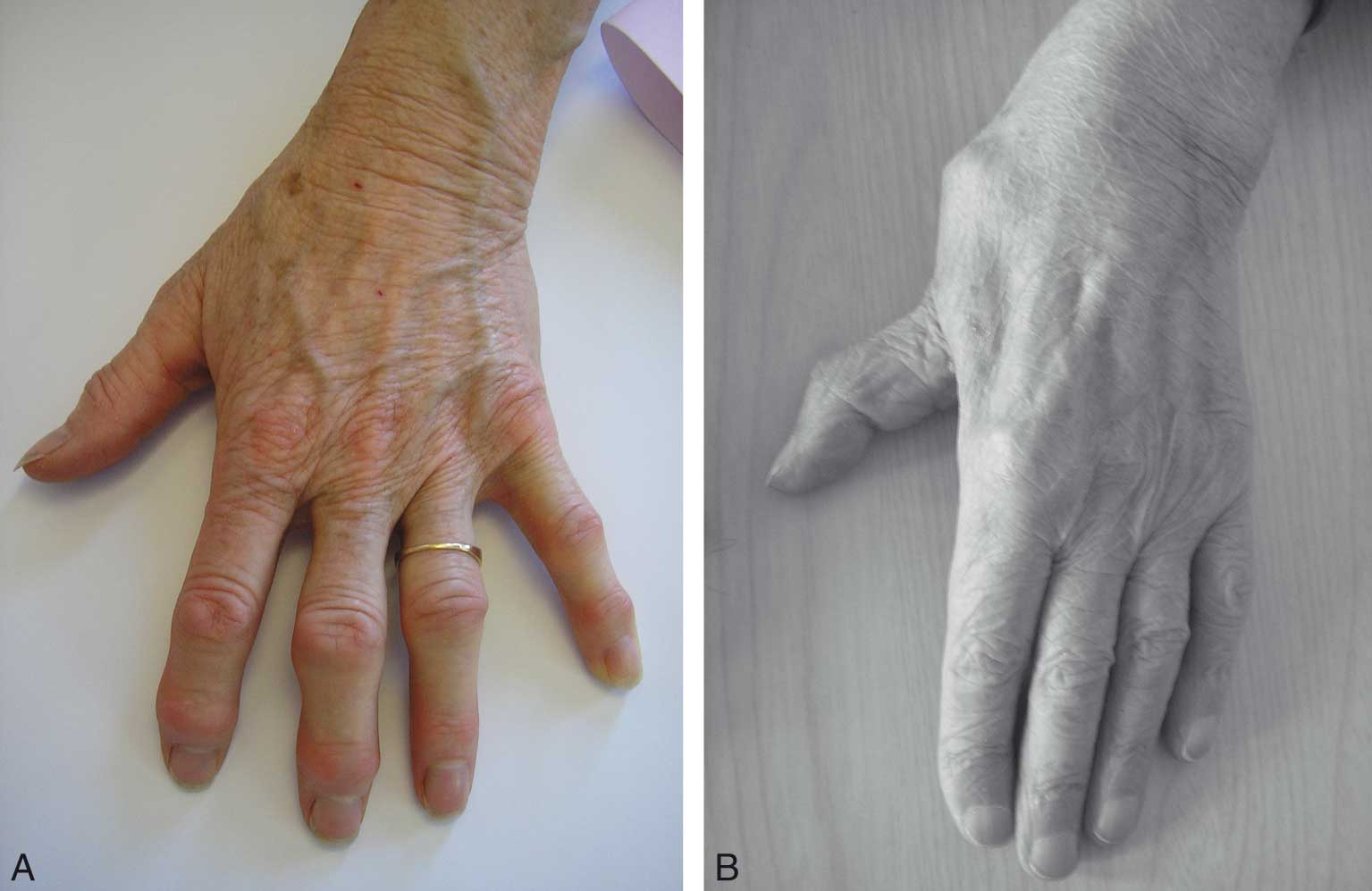Arthrose digitale, les symptômes liés à l'arthrose des mains